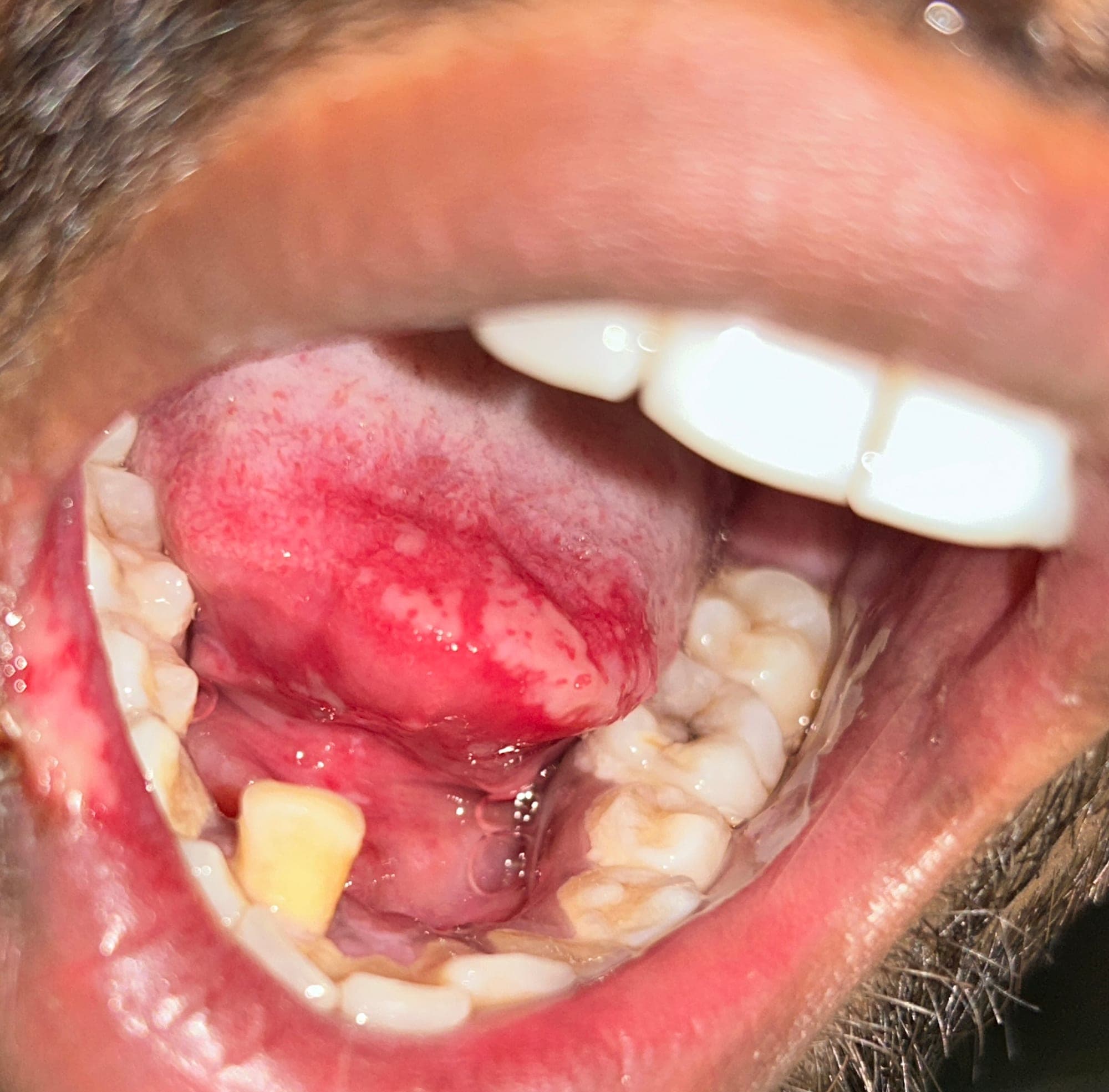 Traumatic ulcer before